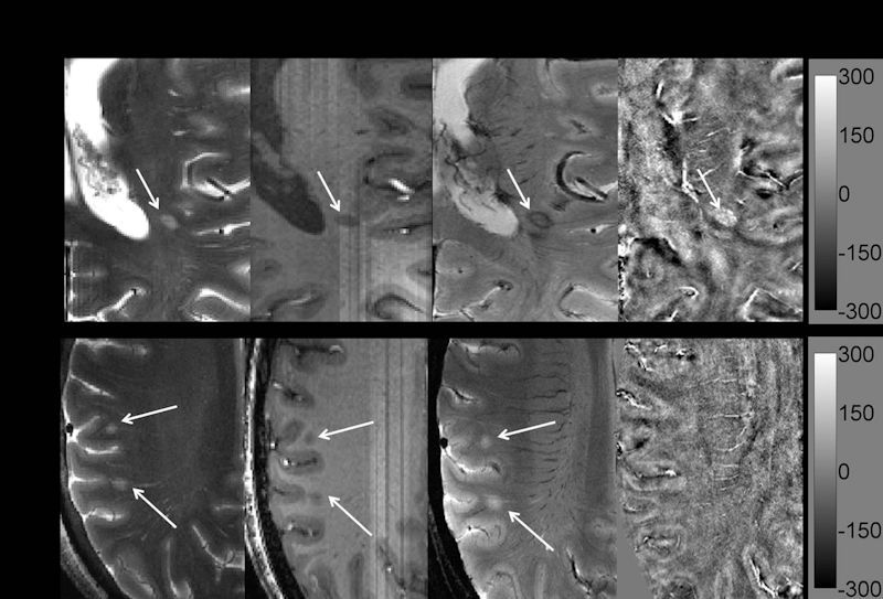 Depositi di ferro cerebrale in paziente con sclerosi multipla