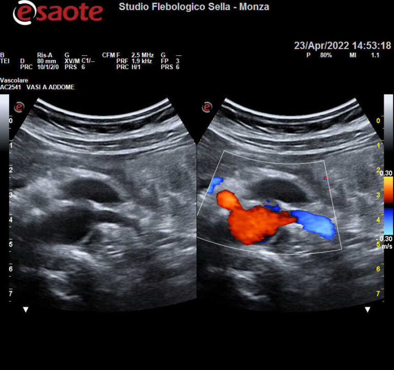 L'EcocolorDoppler delle arterie renali nell'ipertensione resistente ai farmaci.