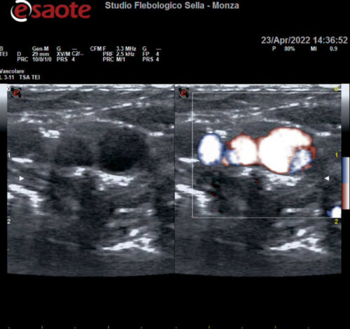 Vertigini persistenti ed EcocolorDoppler tronchi sovraortici: l’importanza delle prove dinamiche.