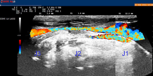 EcocolorDoppler per CCSVI una vena giugulare meiopragica
