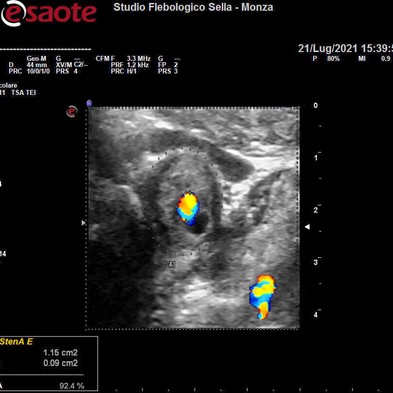 L'EcocolorDoppler dei tronchi sovraortici nella prevenzione dell'ictus