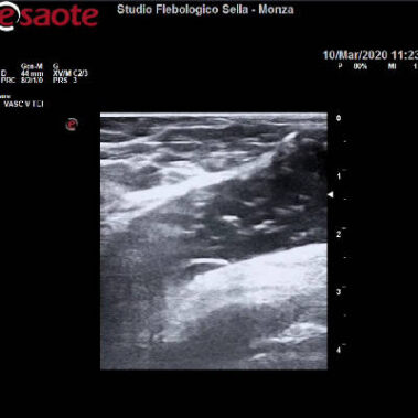 Microbolle di schiuma all'interno di una vena.