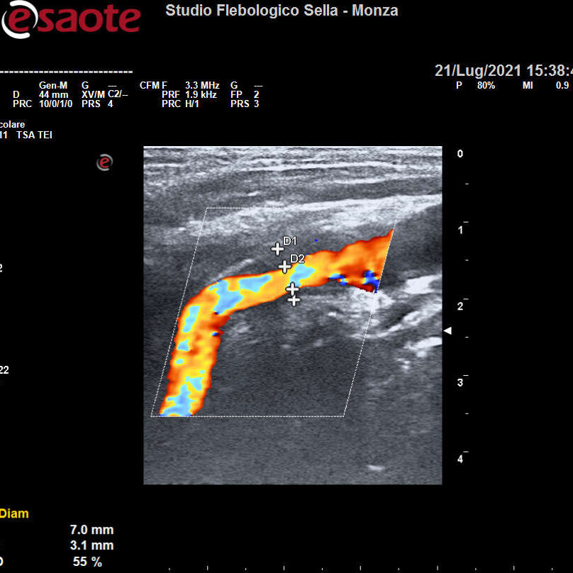 L'EcocolorDoppler dei tronchi sovraortici nella prevenzione dell'ictus