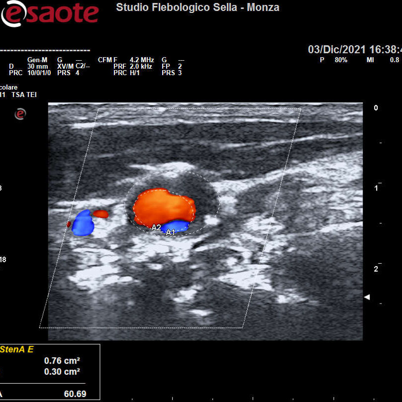 L'EcocolorDoppler dei tronchi sovraortici nella prevenzione dell'ictus