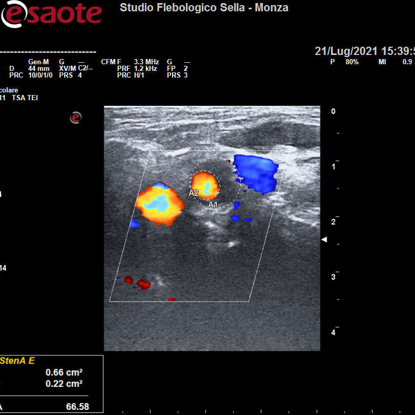 L'EcocolorDoppler dei tronchi sovraortici nella prevenzione dell'ictus