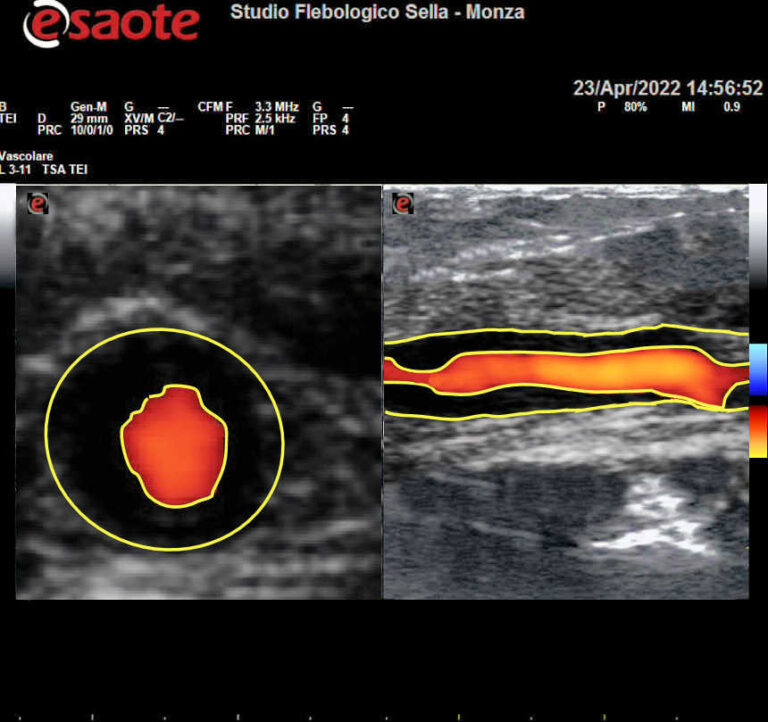 Arterite di Horton all'indagine ecodoppler