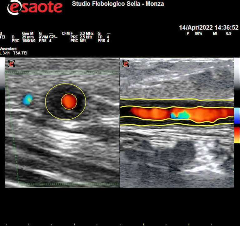 Arterite di Horton all'indagine ecodoppler