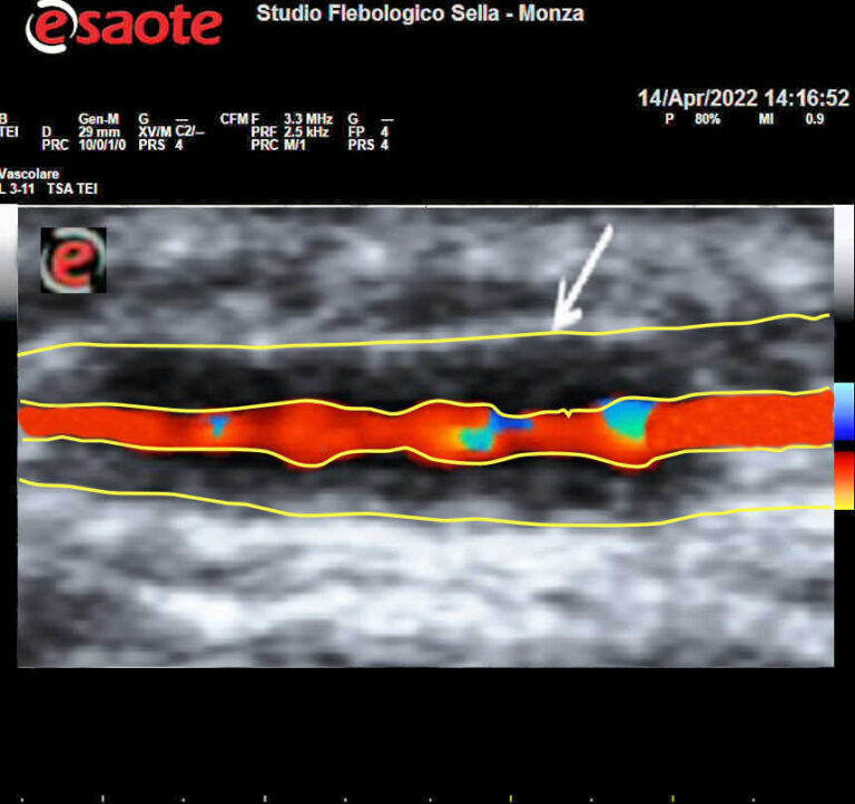 Arterite di Horton all'indagine ecodoppler
