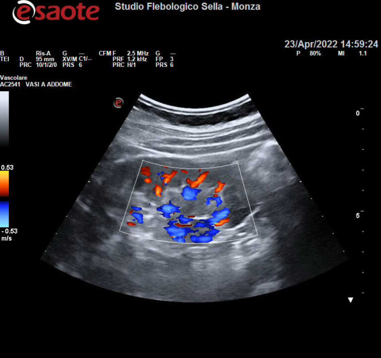 EcocolorDoppler arterie renali e ipertensione arteriosa