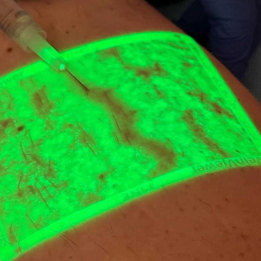 Il Veinviewer nella scleroterapia di varici e capillari