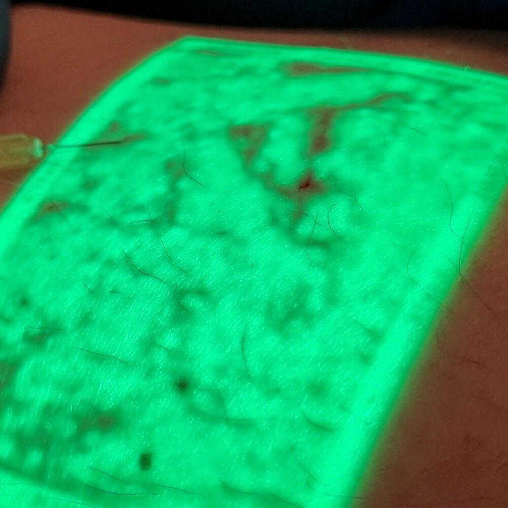 Veinviewer nel trattamento di varici e capillari