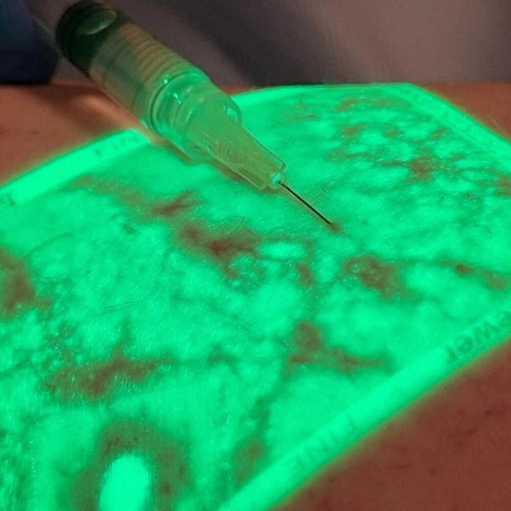 Visualizzatore ad infrarossi di varici e capillari