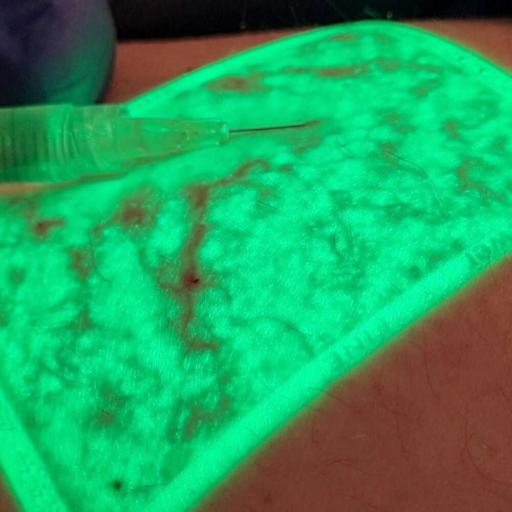 Visualizzatore ad infrarossi di varici e capillari