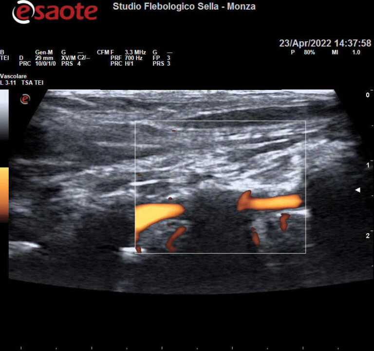 Vertigini persistenti ed EcocolorDoppler tronchi sovraortici: l’importanza delle prove dinamiche.