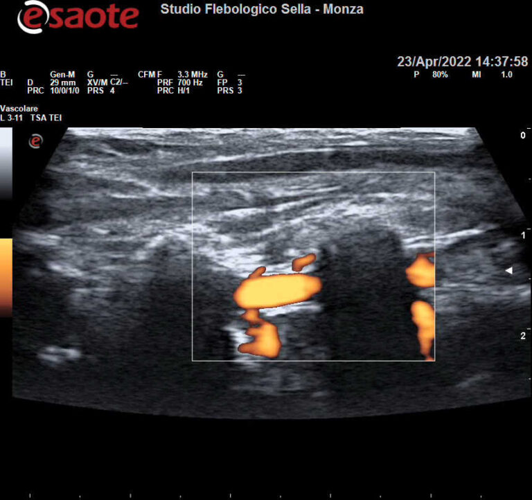 Vertigini persistenti ed EcocolorDoppler tronchi sovraortici: l’importanza delle prove dinamiche.