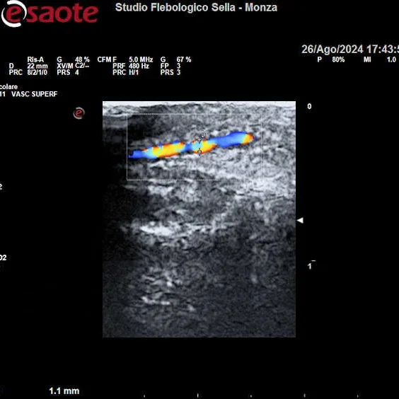 Immagine ecografica di un vaso esaminato con una sonda standard